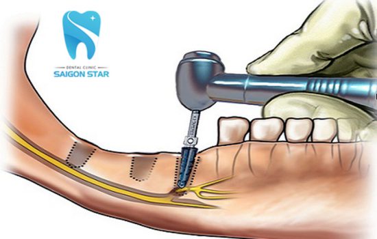 Biến chứng trồng răng Implant là gì? Bác sĩ chia sẻ như sau