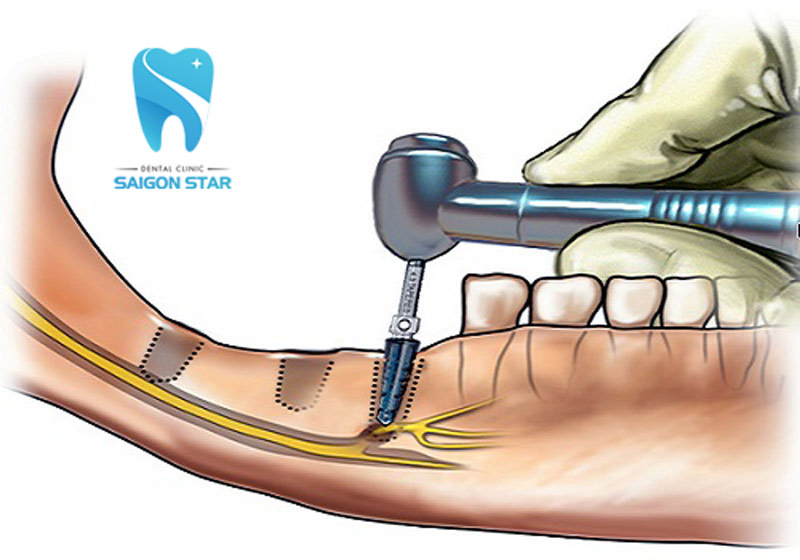 biến chứng trồng răng implant