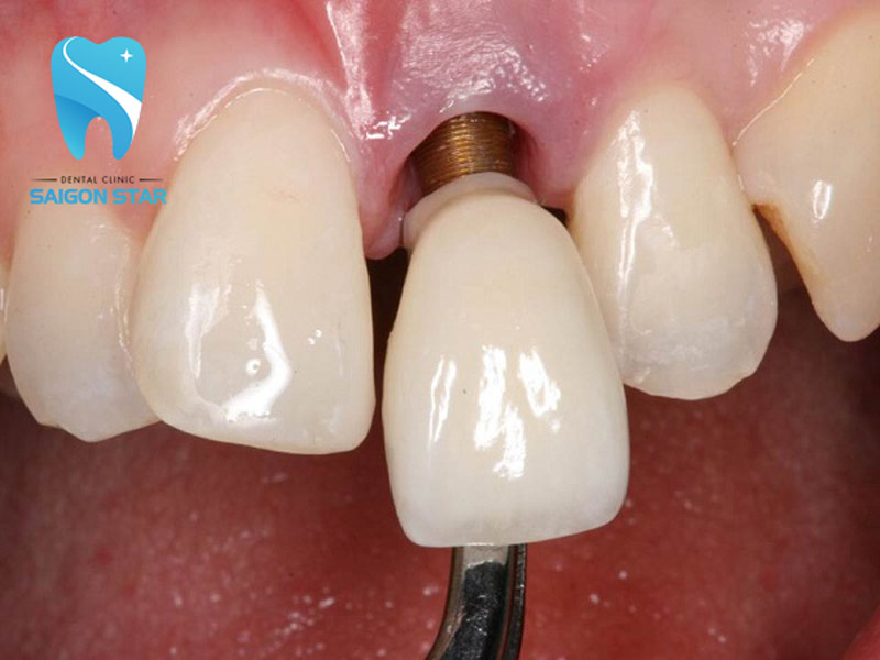 biến chứng trồng răng implant