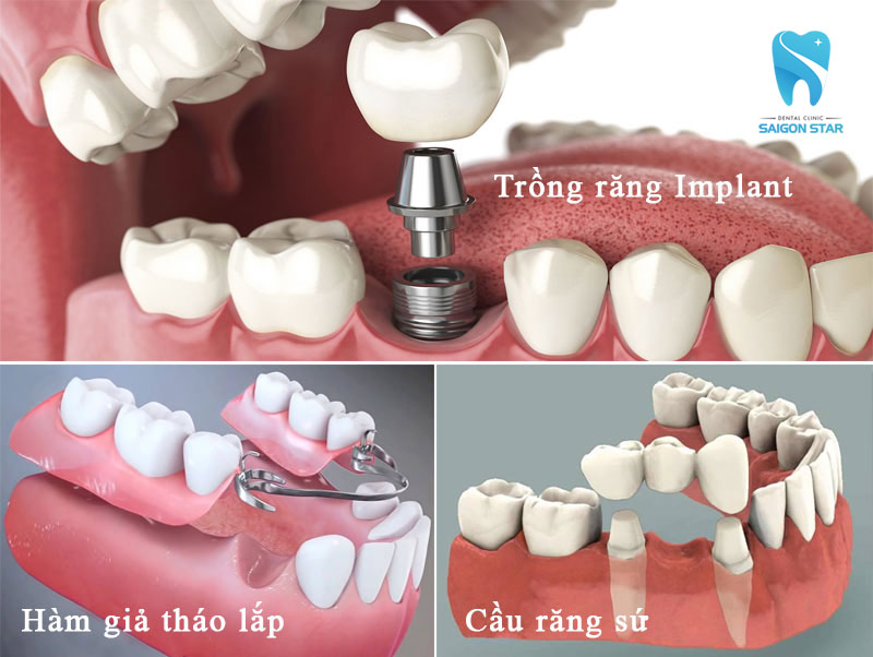 trồng răng hàm mất bao nhiêu thời gian