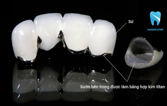 Mão sứ từ hợp kim titan liệu có tốt?