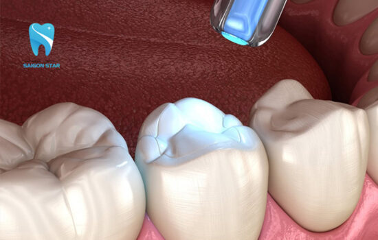 Tác hại của việc trám răng là gì? Chia sẻ của bác sĩ