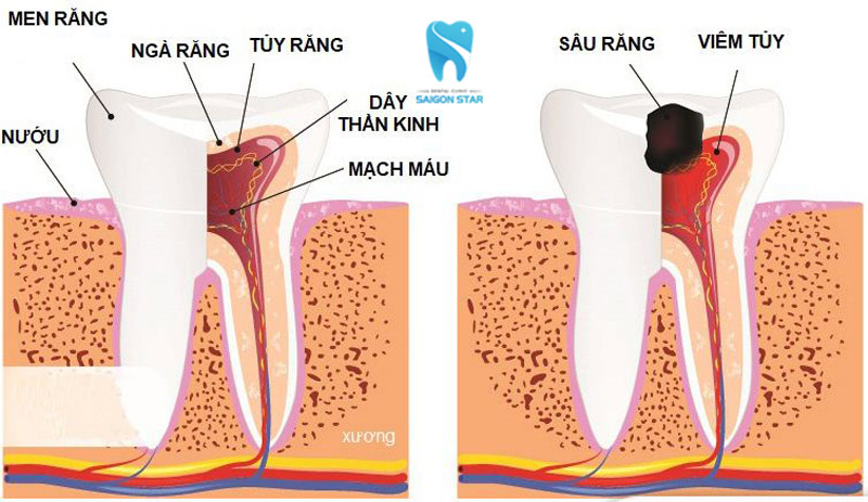 tuỷ răng là gì