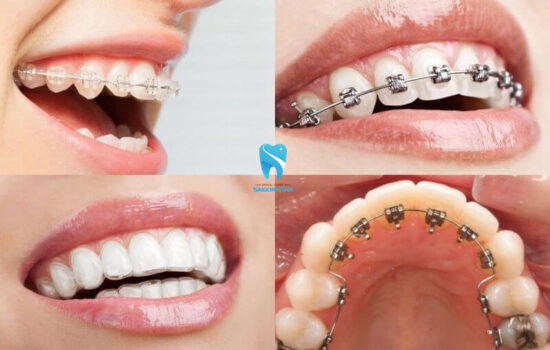 Niềng răng loại nào tốt? Bác sĩ chia sẻ