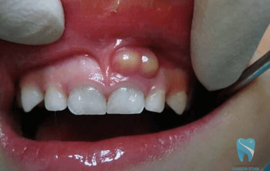 Sưng nướu răng có mủ nguy hiểm hay không?