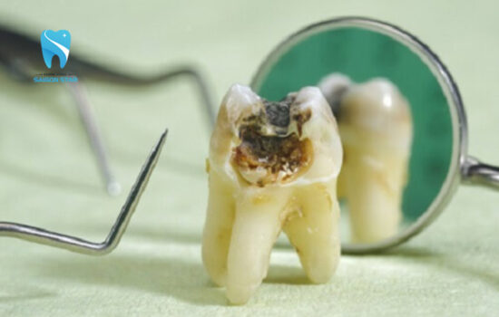 Tuỷ răng bị thối: Nguyên nhân, dấu hiệu và cách điều trị