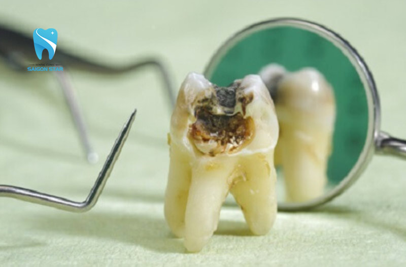 tuỷ răng bị thối